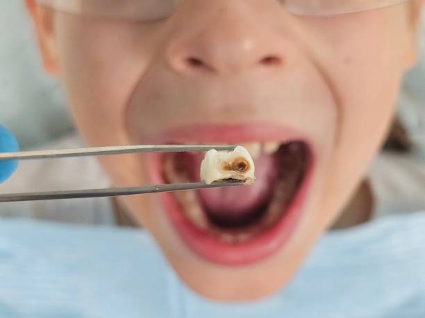 Best Broken or Cracked Tooth Emergency Dentist in Lorenzo, TX